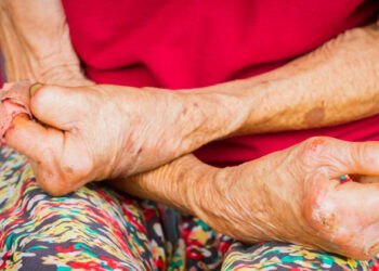 18 പേർക്ക് കുഷ്ഠരോഗം സ്ഥിതീകരിച്ച് ആരോഗ്യ വകുപ്പ്; രോ​ഗബാധിതരിൽ ഒമ്പത് കുട്ടികൾ‌