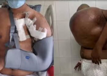 25കാരന് പുതുജീവൻ; 43 കിലോ ഭാരമുള്ള ട്യൂമർ പുറത്തെടുത്ത് കോട്ടയം മെഡി. കോളേജ്