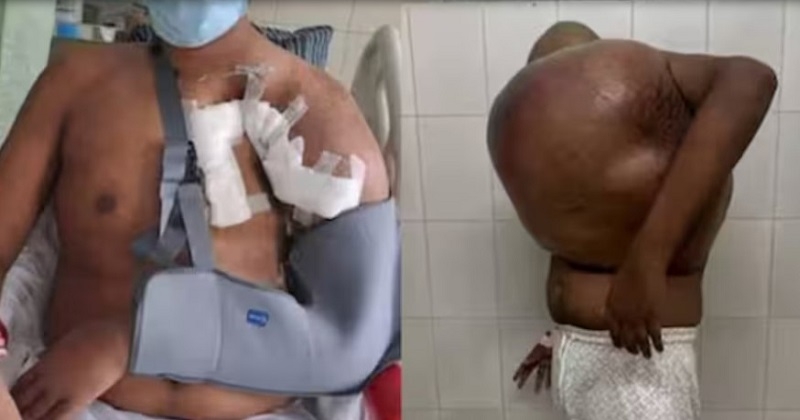 25കാരന് പുതുജീവൻ; 43 കിലോ ഭാരമുള്ള ട്യൂമർ പുറത്തെടുത്ത് കോട്ടയം മെഡി. കോളേജ്