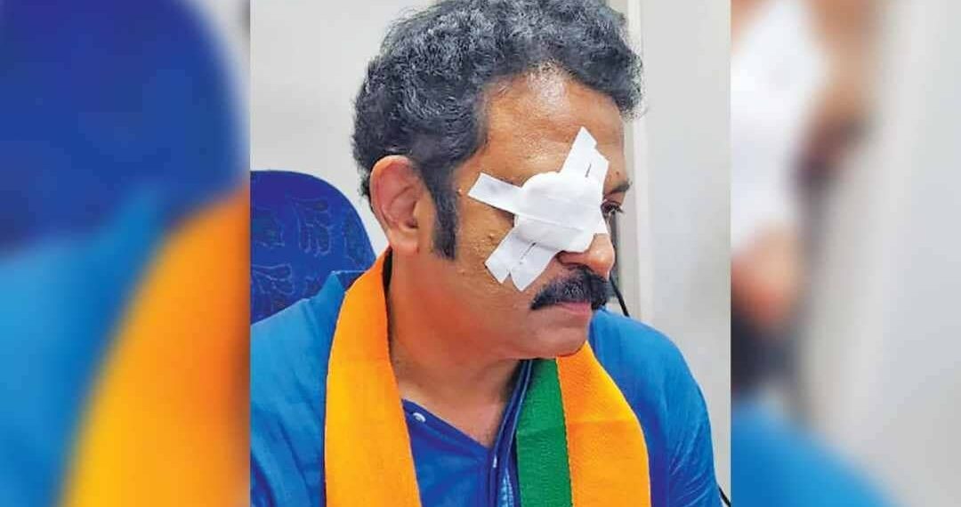 ‘എനിക്കെതിരെ നടന്നത് ബോധപൂര്വമായ ആക്രമണം, മനഃപൂർവ്വം തിരക്കുണ്ടാക്കി കണ്ണില് കുത്തി’: ജി കൃഷ്ണകുമാര്