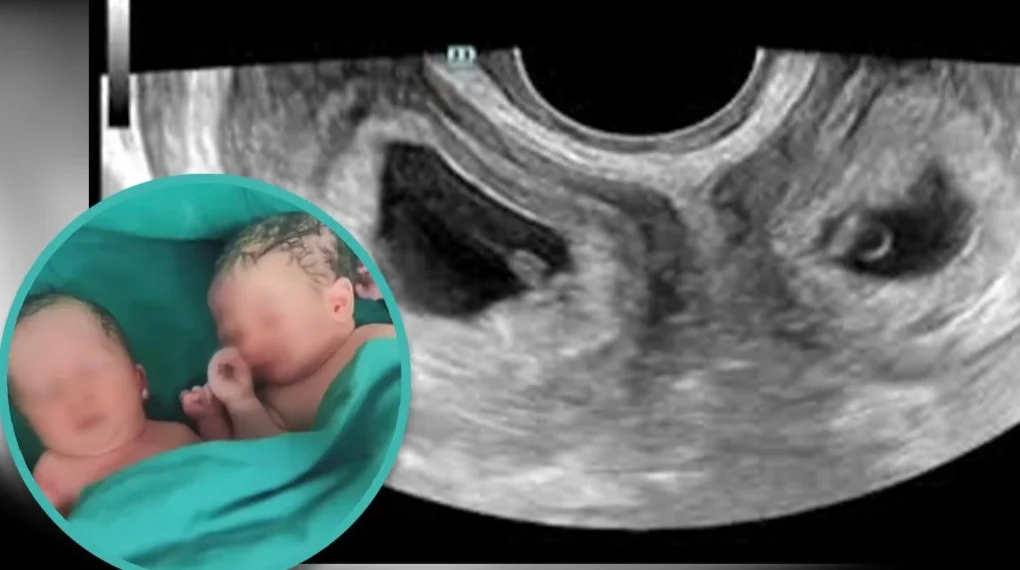 വടക്കു പടിഞ്ഞാറൻ മേഖല സ്വദേശിയായ യുവതിക്ക് രണ്ട് ഗർഭപാത്രം; അമ്പരന്ന് മെഡിക്കൽ വിദഗ്ധർ