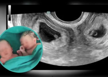 വടക്കു പടിഞ്ഞാറൻ മേഖല സ്വദേശിയായ യുവതിക്ക് രണ്ട് ​ഗർഭപാത്രം; അമ്പരന്ന് മെഡിക്കൽ വിദ​ഗ്ധർ