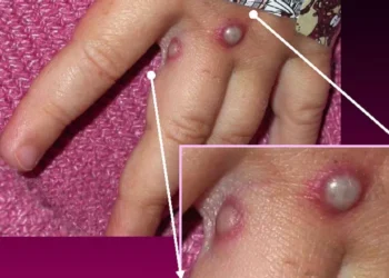 എംപോക്സ്: സംസ്ഥാനത്ത് നിരീക്ഷണം ശക്തമാക്കി; വിമാനത്താവളങ്ങളിൽ കർശന പരിശോധന