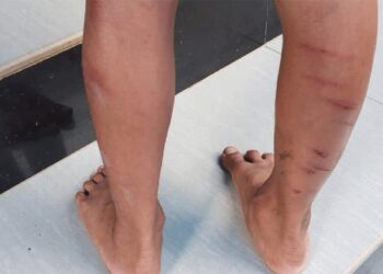 യുകെജി വിദ്യാർത്ഥിയെ തല്ലി പരിക്കേൽപ്പിച്ചു; അധ്യാപിക ഒളിവിൽ